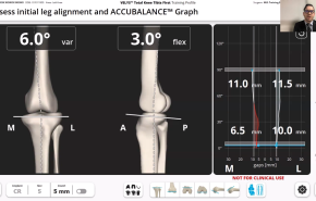 Image from VELYS Robotic-Assisted Solution Case Walkthough with Dr. Timothy Alton