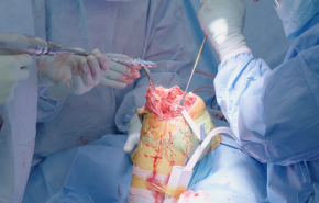 Image from ATTUNE™ Revision Knee System: Live Surgical Procedure - Wayne Moschetti, MD