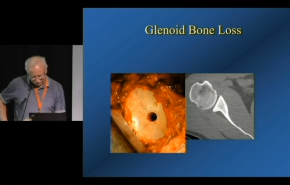 Image from Dealing with Glenoid Bone Loss - Carl Basamania, MD
