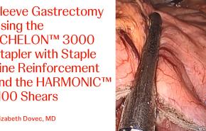 An Image From "Sleeve Gastrectomy Using the ECHELON™ 3000 Stapler with Staple Line Reinforcement and Harmonic™ 1100 Shears with Betsy Dovec, MD