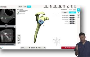TRUMATCH Software Review: Reverse Total Shoulder - Anand Murthi, MD thumbnail