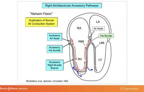 An Image From "Use of ECG and Intracardiac Recordings to Diagnose and Demonstrate the Electrophysiologic Characters of Atriofascicular and Atroventricular Type "Mahaim" Fibers with Warren 'Sonny' Jackman, MD"