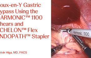 An Image From "Roux-en-Y Gastric Bypass Using the HARMONIC™ 1100 Shears and ECHELON™ Flex ENDOPATH™ Stapler with Kelvin Higa, MD"