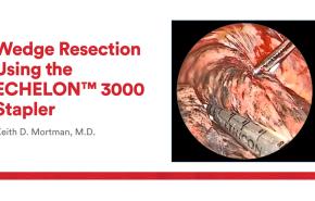 An Image From "Wedge Resection Using the ECHELON™ 3000 Stapler with Keith Mortman, MD"