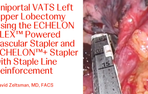 An Image From "Uniportal VATS Left Upper Lobectomy Using the ECHELON FLEX™ Powered Vascular Stapler and ECHELON™+ Stapler with Staple Line Reinforcement with David Zeltsman, MD"