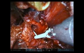 An Image From "Robotic Prostatectomy Using STRATAFIX™ Spiral Knotless Tissue Control Device with Jorn Witt, MD"