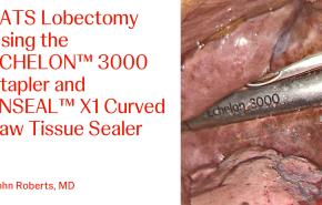 An Image From "Watch this video to learn more as Dr. Roberts performs a VATS procedure using the ECHELON™ 3000 stapler. This content is intended for Health Care Professionals in the United States. "