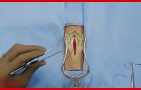 Abdominal Closure