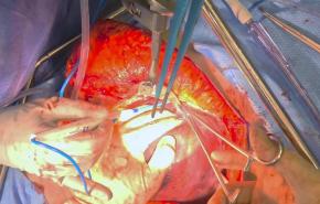 Right Hepatectomy - Mobilize Liver