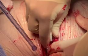 Coronary Artery Bypass Grafting (CABG) - Sternotomy Hemostasis