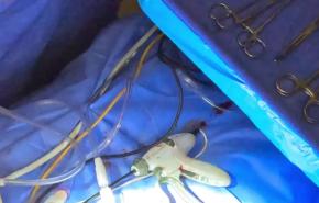 Right Hepatectomy - Parenchymal Transection