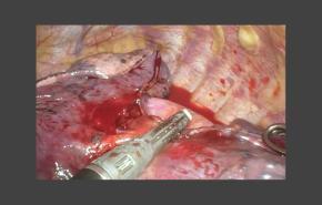 Repair during Right Upper Lobectomy with Zane Hammoud, MD