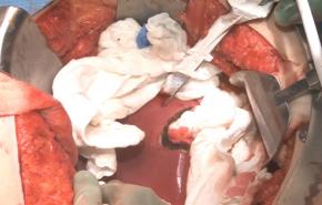 An image from the "Ultrasound Guided Open Liver Ablation with Steven Trocha, MD" video on the JnJInstitute.com website.