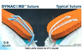 An image of the "Smart Suture Technology - The Future of Soft Tissue Repair" video.