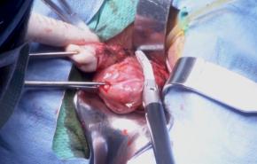 An image from the "Total Vaginal Hysterectomy using the ENSEAL® X1 Large Jaw with Steven McCarus, MD" video on the JnJInstitute.com website.