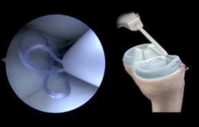 An image of the "Anterior Meniscal Repair Video using TRUESPAN™ Meniscal Repair System with Tony Nguyen, MD" video on the JnJInstitute,com website.