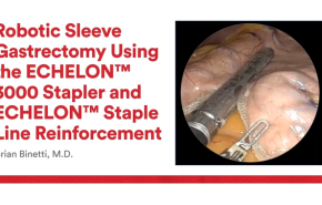 An Image From "Robotic Sleeve Gastrectomy Using the ECHELON 3000 Stapler and ECHELON Staple Line Reinforcement with Brian Binetti, MD"