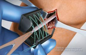 Innovations in Soft Tissue ACL Reconstruction and Meniscal Repair