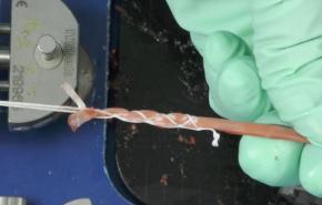 An image from the"SPEEDTRAP™ Graft Preparation SysteACL Reconstruction - Hamstring Harvest Utilizing SPEEDTRAP™ Graft Preparation System with Amir Moinfar, MDm with Amir Moinfar, MD" video on the JnJInstitute.com website.