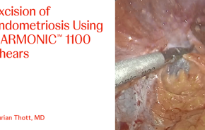 An Image From "Excision of Endometriosis Using HARMONIC™ 1100 Shears with Kurian Thott, MD"