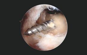 An image of the "Subscapularis Repair Featuring the EXPRESSEW® III Autocapture+ Flexible Suture Passer (Shoulder Arthroscopy)" video.