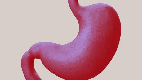 Laparoscopic Sleeve Gastrectomy