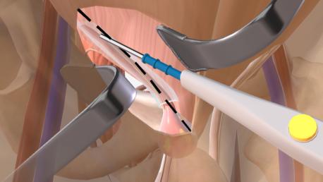 Inguinal Hernia Repair Open