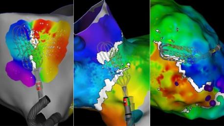 OPTRELL Mapping Catheter Image