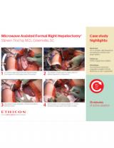An image of the "Microwave Assisted Formal Right Hepatectomy Case Study with Stevem Trocha, MD" case study on the JnJInstitute.com website.