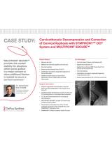 An image from the "Cervicothoracic Decompression & Correction of Cervical Kyphosis with SYMPHONY™ OCT System & MULTIPOINT SECURE™ with Daniel Refai, MD" PDF on the JnJInstitute.com website.