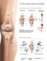 An image of the "Knee Replacement Anatomical Poster" pdf on the JnJInstitute.com website.