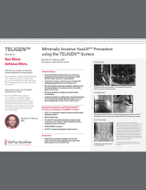 An Image From "Minimally Invasive VueLIF Procedure using the TELIGEN™ System - Brooks Osburn, MD"