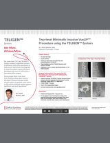 An Image From "Two-level Minimally Invasive VueLIF Procedure using the TELIGEN™ System - Ankit Mehta, MD"