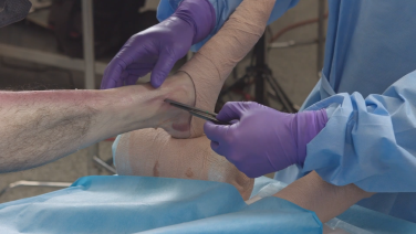 TFN-ADVANCED Tibial Nailing System Surgical Procedures with Matthew Graves, MD