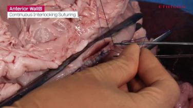 Hand Sewn Gastrojejunostomy