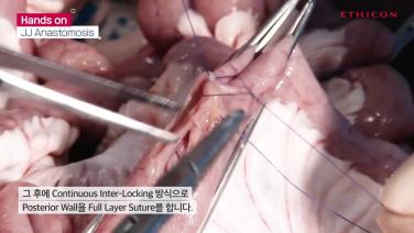 Hand-Sewn Jejunojejunostomy (Voice+)