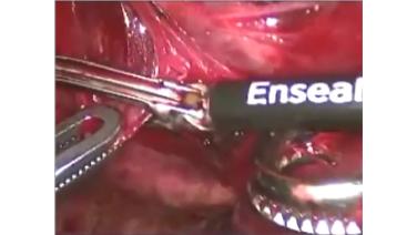 ENSEAL® G2 Articulating Advanced Energy Tissue Sealer with Daniel Miller, MD