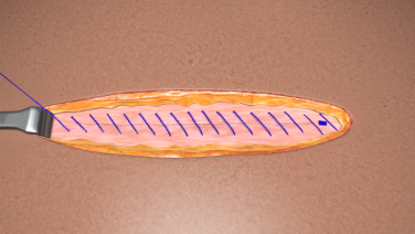 An image from the "STRATAFIX™ Symmetric PDS™ Plus Knotless Tissue Control Device in Open Wound Closure Procedures" video on the JnJInstitute.com website.