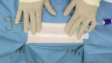 An Image From "DERMABOND PRINEO 22 Technique Video"