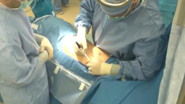 Lobectomy Incision & Port Placement with Traves Crabtree, MD