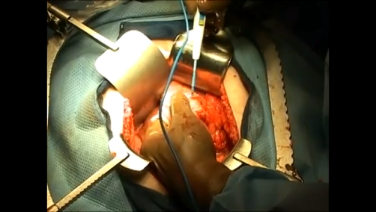 Left Sigmoid Colectomy Using the ETHICON ENDO-SURGERY Linear Cutter with Lee Pederson, MD