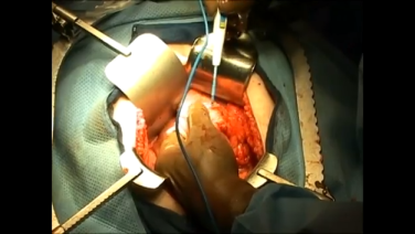 Left Sigmoid Colectomy Using the ETHICON ENDO-SURGERY Linear Cutter with Lee Pederson, MD