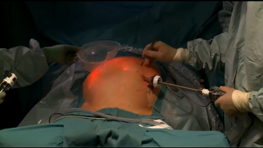 Laparoscopic Right Hemicolectomy using HARMONIC ACE®+ Shears with Richard Dworken, MD