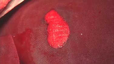 An image of the "SURGIFLO Hemostatic Matrix Kit in a Moderate Bleeding Liver Crack" video.