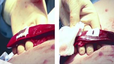 An image of the "SURGICEL SNoW™ vs SURGICEL® Original Hemostatic Efficacy Study" video on the JnJInstitute.com website.