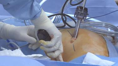 An image of the "Laparoscopic Lower Anterior Resection with Splenic Flexure Mobilization - David Longcope, MD" video.