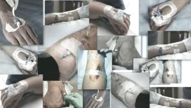An image showing multiple peripheral IV catheters using BIOPATCH.