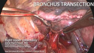 Bronchus Transection during Right Upper Lobectomy with Zane Hammoud, MD