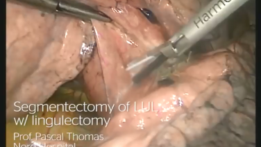 An image of the "Segmentectomy of LUL with Lingulectomy by Pascal Thomas, MD" video on the JnJInstitute.com website.