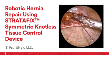 An Image From "Robotic Hernia Repair using STRATAFIX™ Symmetric Knotless Tissue Control Device with T. Paul Singh, MD "